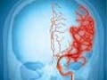 FM-04 Cerebrovascular Disorder