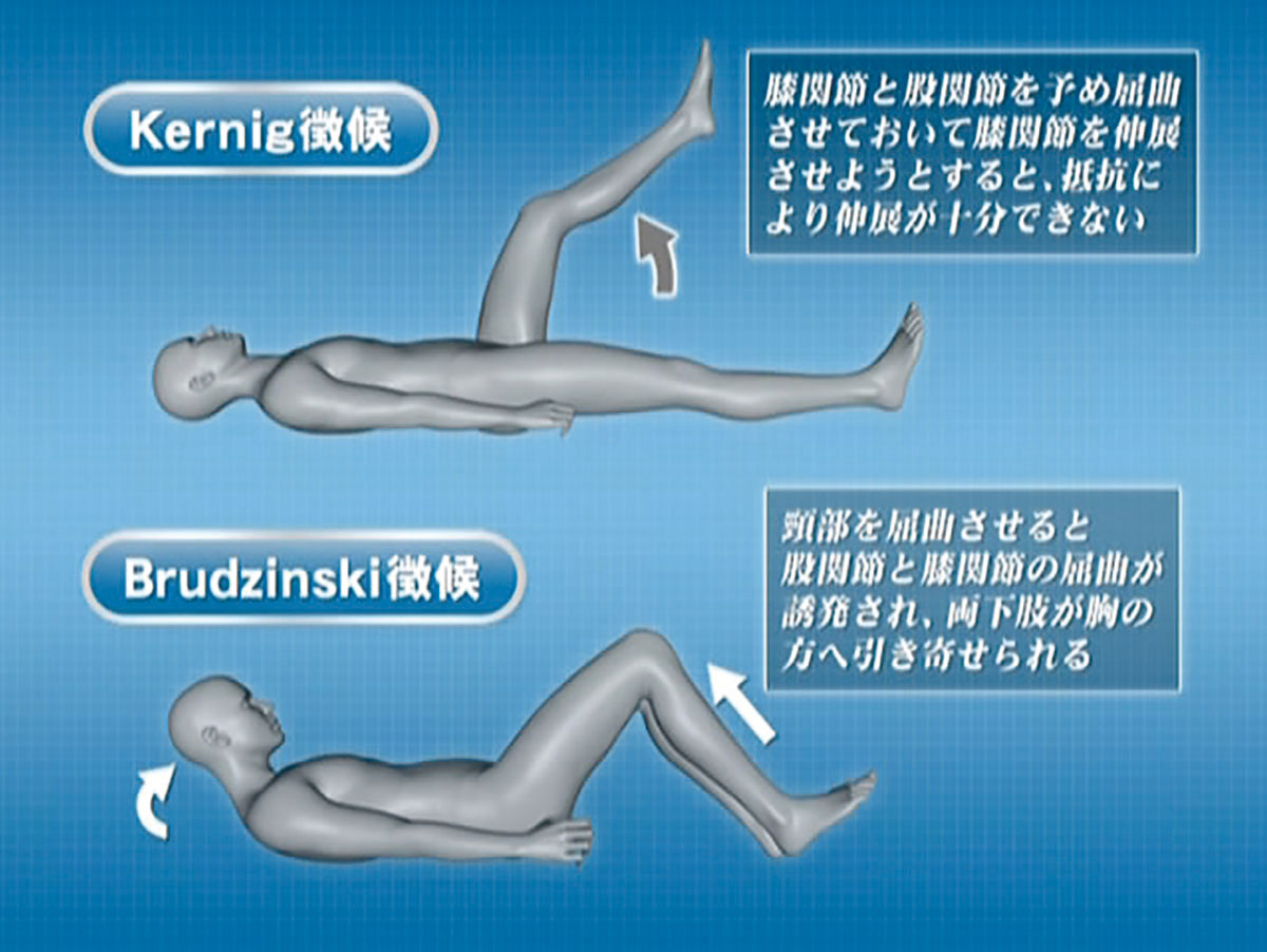 ePFJ-04 頭痛