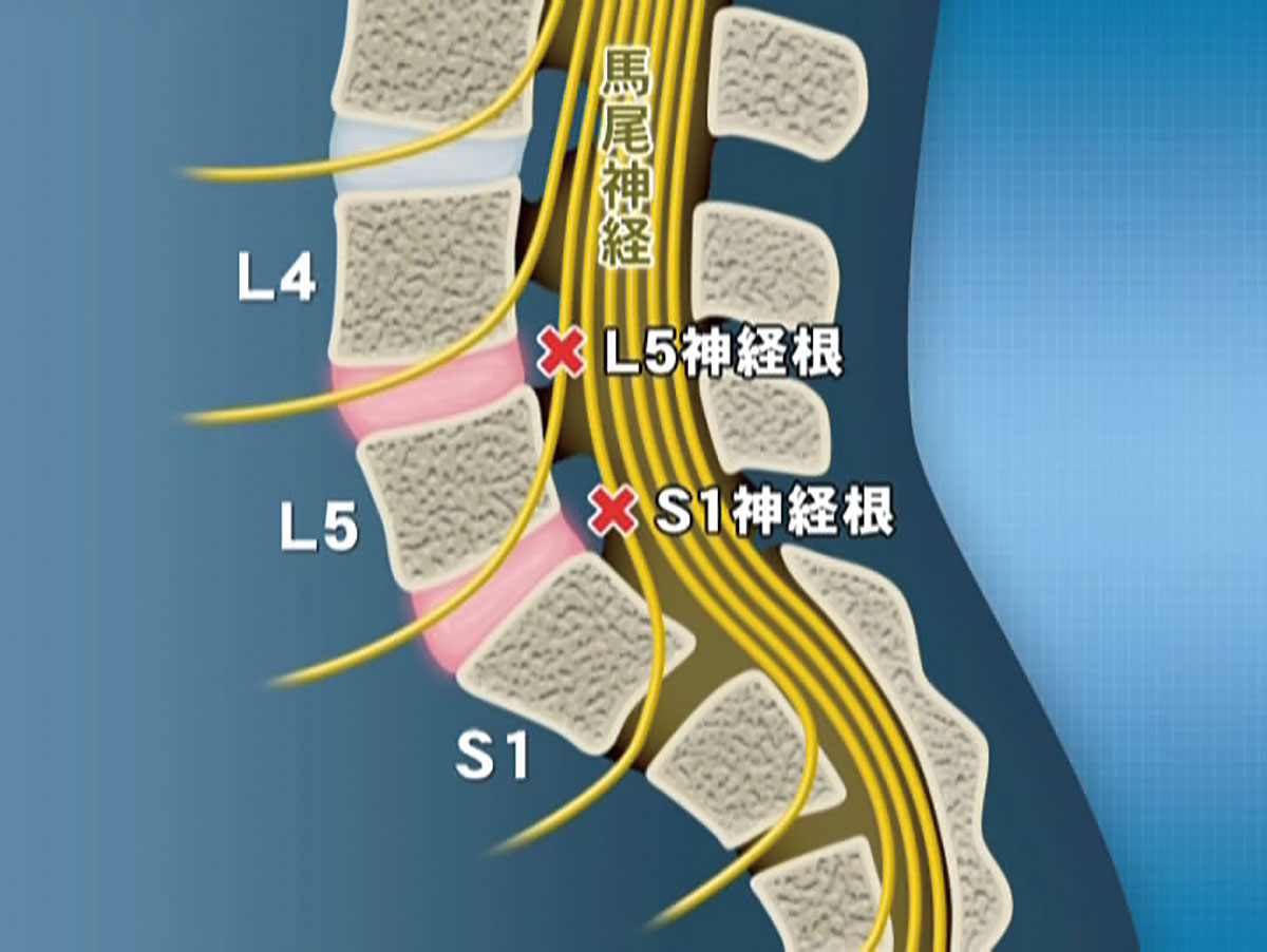 ePFJ-10 腰痛